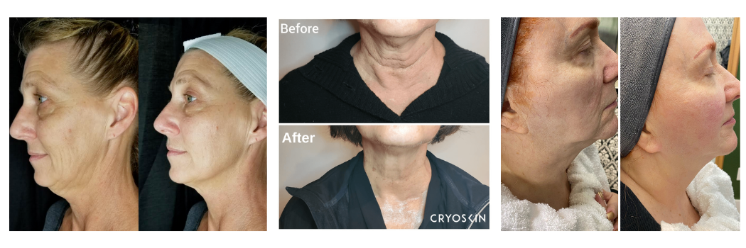 Donna-CryoFacial-Photos