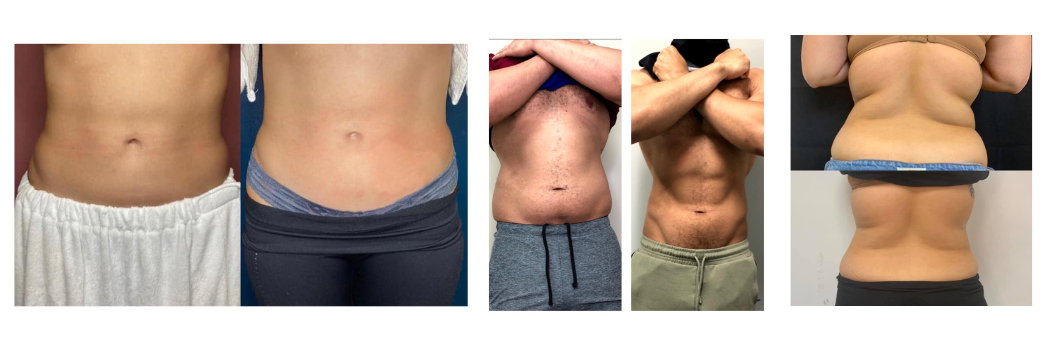 Donna-CryoSlimming-Photos